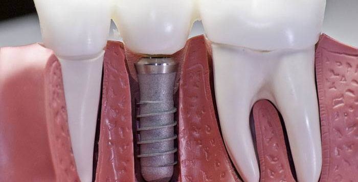 Implant dentaire : pourquoi est-ce aussi cher ?