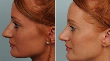 Une meilleure connaissance de la rhinoplastie, la chirurgie du nez