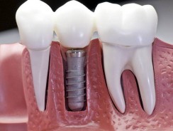 Implant dentaire : pourquoi est-ce aussi cher ?